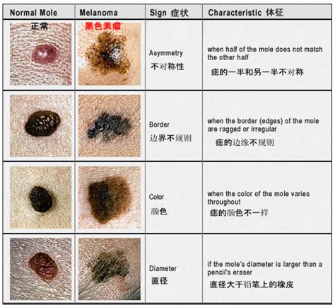 黑痣凸起|痣也可能会癌变！长在 3 个地方要注意